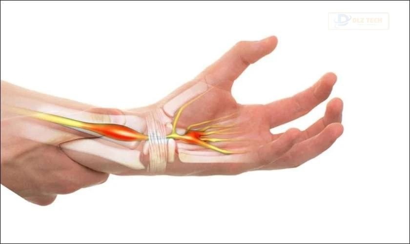 Giảm rủi ro mắc hội chứng ống cổ tay